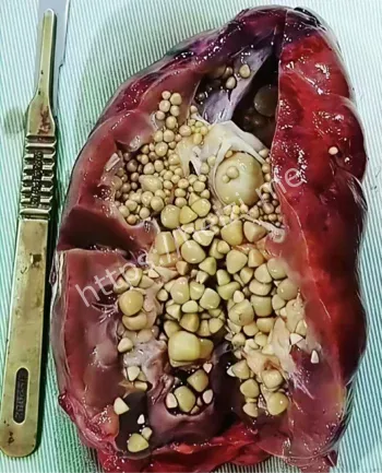 花小烙肾结石痛哭